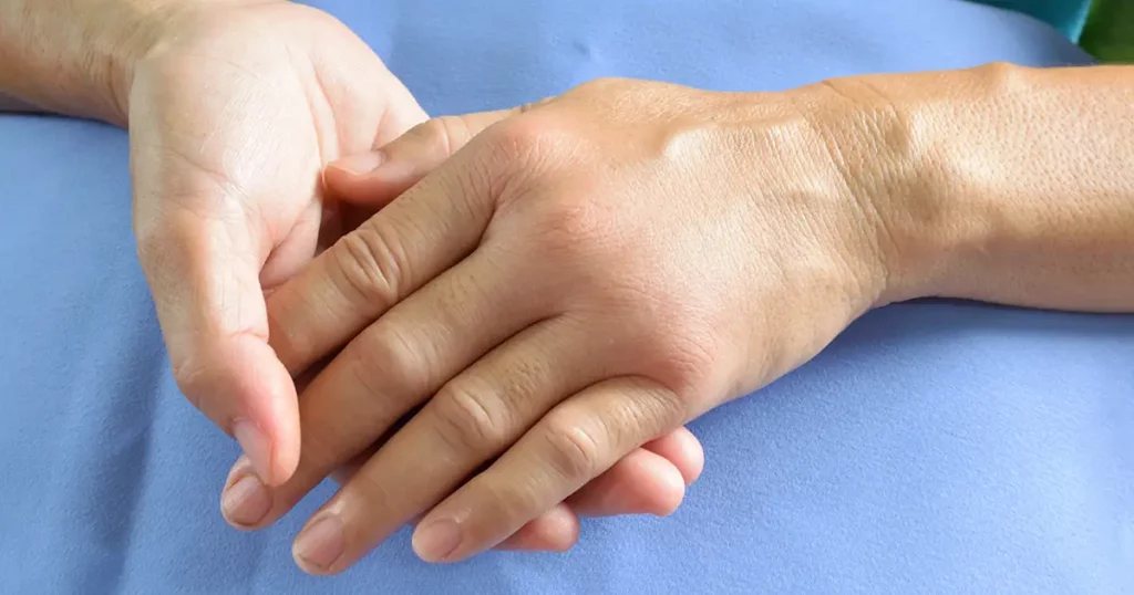 Woman's hand with a swelling.